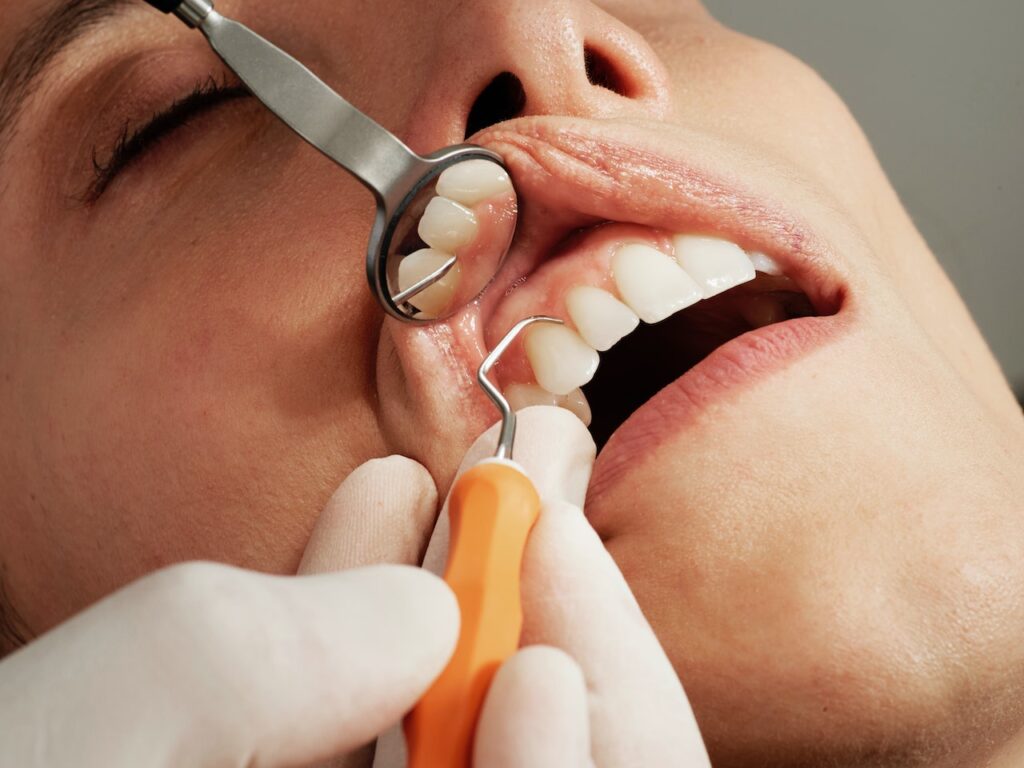 Your Options for Repairing Chipped Teeth