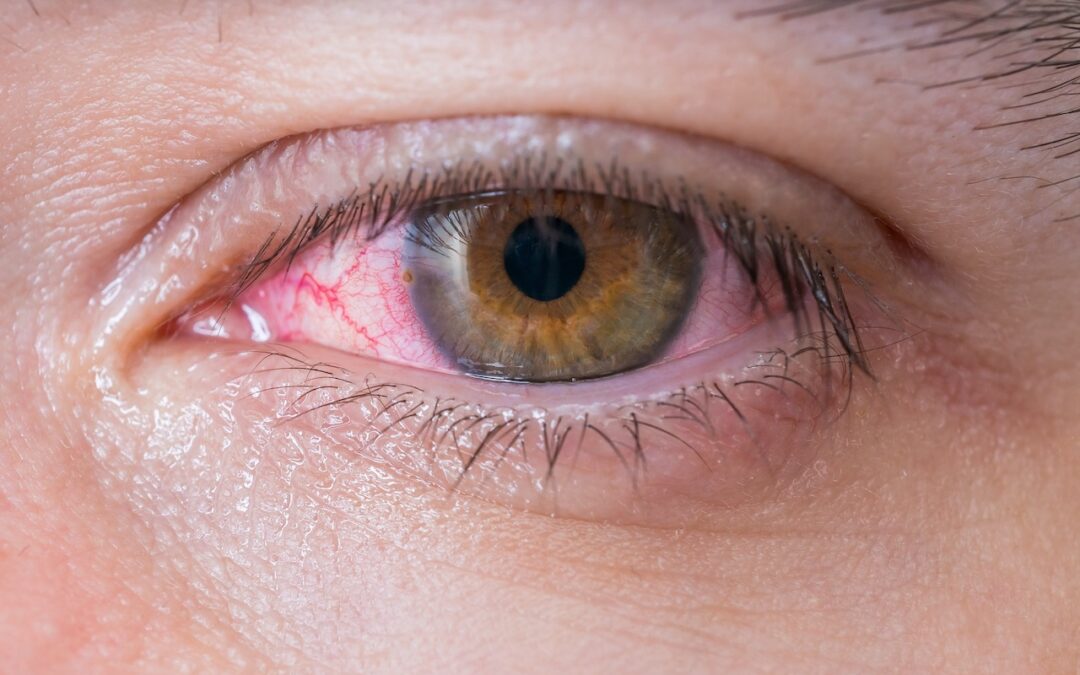 How Do You Treat Pink Eye?