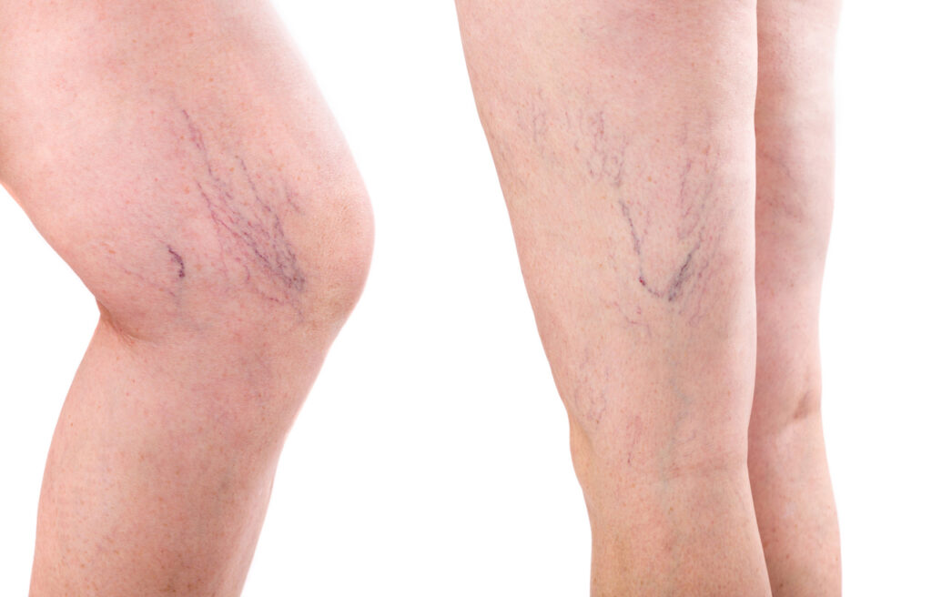 What Are Spider Veins and How Are They Treated?